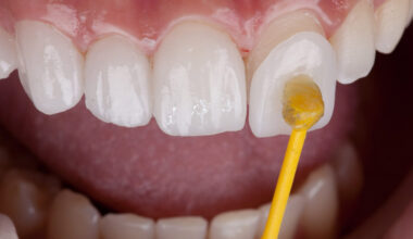 understanding tooth enamel changes during the veneer procedure