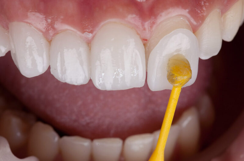 understanding tooth enamel changes during the veneer procedure