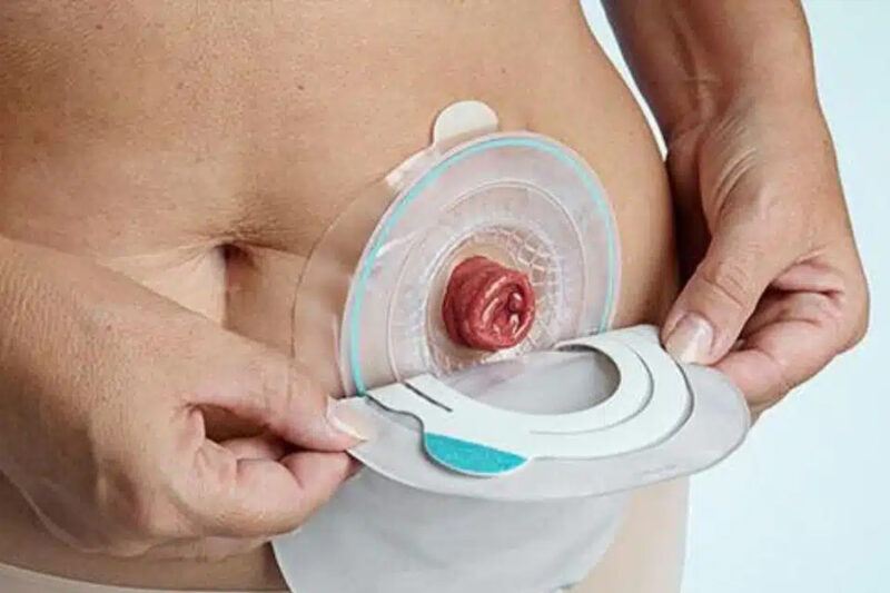 life expectancy with colostomy bag living fully after ostomy surgery