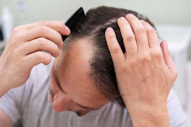 how alopecia treatments support early hair recovery effectively