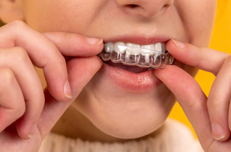 essential invisalign post care tips following treatment completion in kelowna