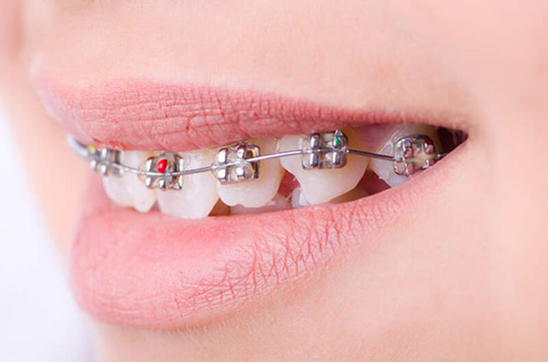 how an orthodontist teeth alignment issues