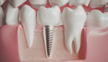 understanding all on four dental implants