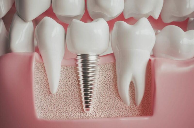 understanding all on four dental implants