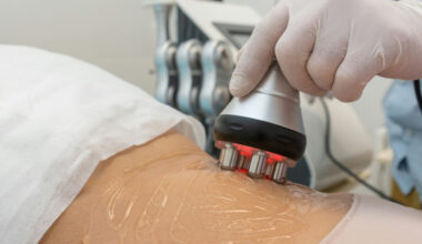 understanding radio frequency skin tightening