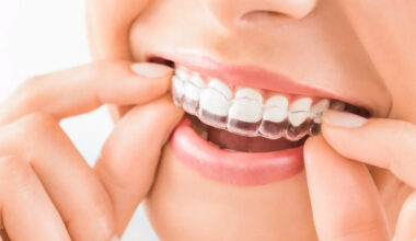 ways invisalign treatment in kelowna straightens teeth