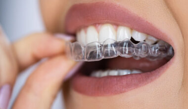 why expert orthodontists suggest clear aligners for patients in south surrey
