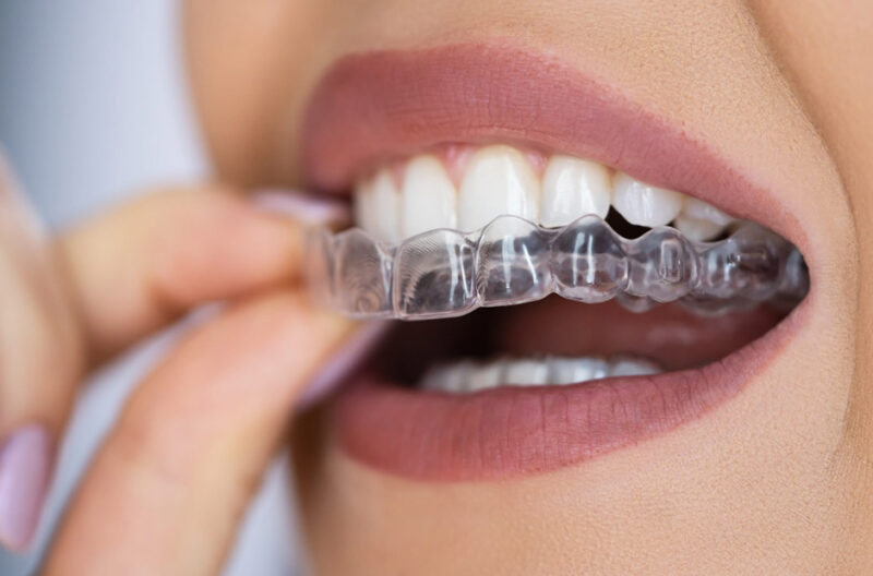 why expert orthodontists suggest clear aligners for patients in south surrey