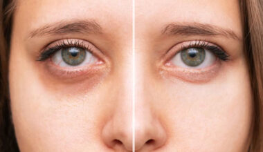 when tired eyes make you look older than you feel