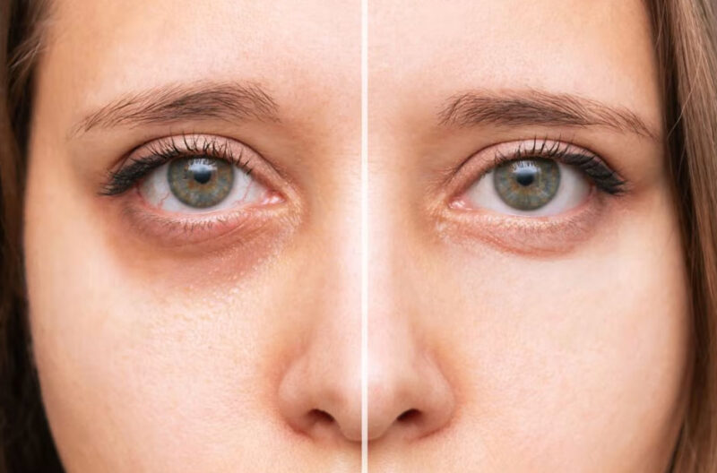 when tired eyes make you look older than you feel